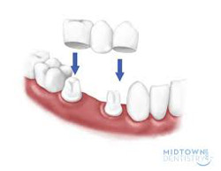 Dental Bridges- Elmwood Park