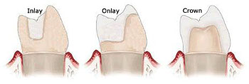 Dental Inlays-Onlays - Elmwood Park