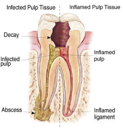 Root Canal - Elmwood Park